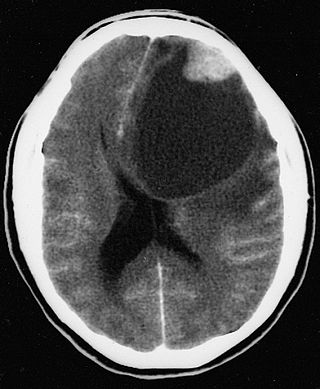 <span class="mw-page-title-main">Pleomorphic xanthoastrocytoma</span> Medical condition