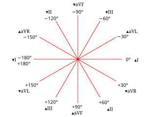 Right axis deviation