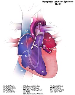 Hypoplastic left heart syndrome Type of congenital heart defect