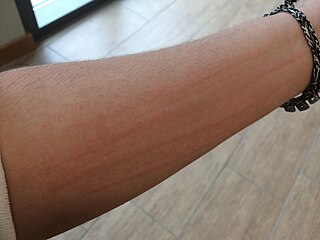 <span class="mw-page-title-main">Physical urticaria</span> Medical condition