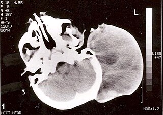 <span class="mw-page-title-main">Rhabdomyosarcoma</span> Cancer originating in precursors to muscle cells