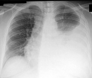 <span class="mw-page-title-main">Thoracentesis</span> Removal of fluids/air from the pleural cavity of the lungs