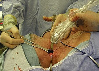 <span class="mw-page-title-main">Lymphadenectomy</span> Medical procedure