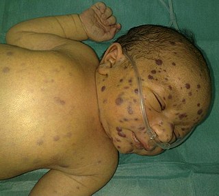 <span class="mw-page-title-main">Blueberry muffin baby</span> Purplish skin bumps on a newborn due to overproduction of blood