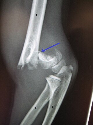 <span class="mw-page-title-main">Supracondylar humerus fracture</span> Medical condition