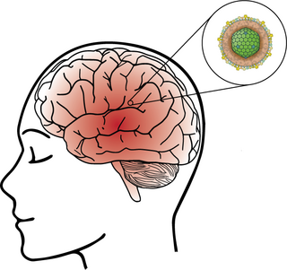 <span class="mw-page-title-main">Viral encephalitis</span> Medical condition