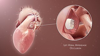 <span class="mw-page-title-main">Left atrial appendage occlusion</span> Medical treatment