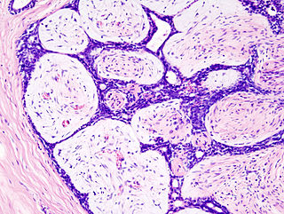 <span class="mw-page-title-main">Fibroadenoma</span> Medical condition