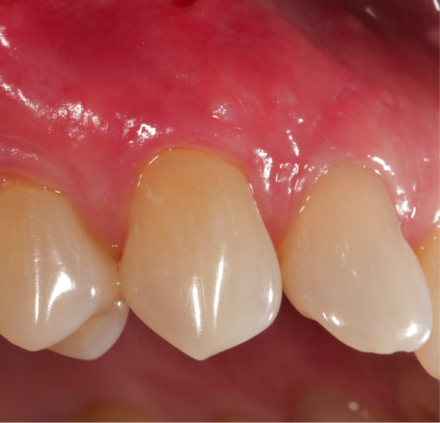 Post-gingival graft Final-result.png