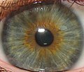 Heterocromia central