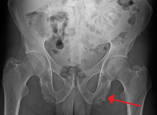 <span class="mw-page-title-main">Enthesopathy</span> Disorder in the attachment of a ligament or tendon to a bone