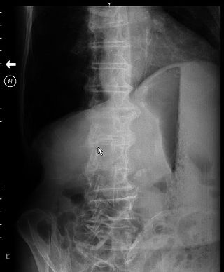 <span class="mw-page-title-main">Gastric outlet obstruction</span> Medical condition