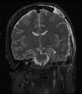 <span class="mw-page-title-main">Intracranial pressure</span> Pressure exerted by fluids inside the skull and on the brain