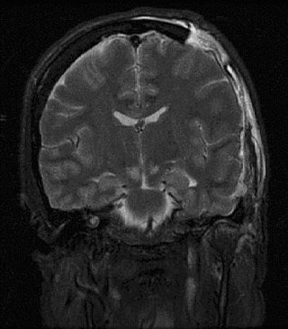 <span class="mw-page-title-main">Brain herniation</span> Potentially deadly side effect of very high pressure within the skull