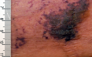 <span class="mw-page-title-main">Calciphylaxis</span> Medical condition