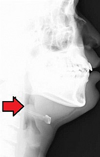 Epiglottitis Inflammation of the epiglottis