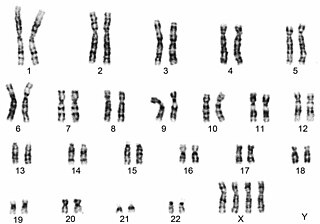 <span class="mw-page-title-main">Tetrasomy X</span> Chromosomal disorder with 4 X chromosomes