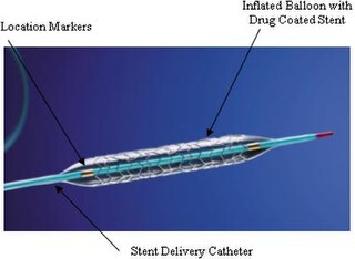 <span class="mw-page-title-main">Coronary stent</span> Medical stent implanted into coronary arteries