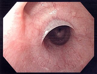 <span class="mw-page-title-main">Esophageal web</span> Abnormal membrane in the esophagus