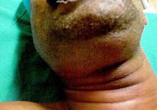 <span class="mw-page-title-main">Ludwig's angina</span> Form of severe cellulitis of the mouth floor