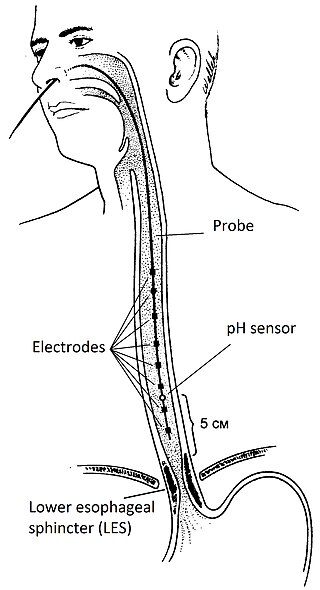 <span class="mw-page-title-main">Impedance–pH monitoring</span>