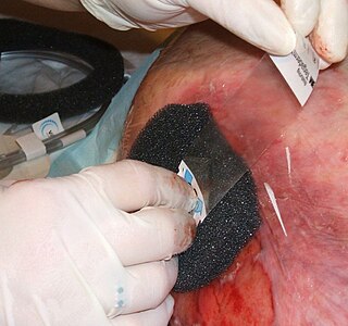 <span class="mw-page-title-main">Negative-pressure wound therapy</span> Therapeutic technique