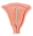 hormonalna intrauterina naprava