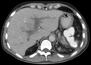 <span class="mw-page-title-main">Portal vein thrombosis</span> Disease of the liver