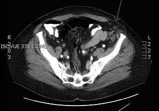 <span class="mw-page-title-main">Spigelian hernia</span> Surgical condition