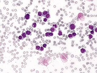 <span class="mw-page-title-main">Acute megakaryoblastic leukemia</span> Blood marrow cancer originating in megakaryoblast cells