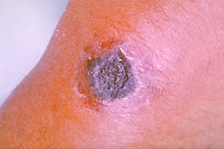 <span class="mw-page-title-main">Anthrax</span> Infection caused by Bacillus anthracis bacteria