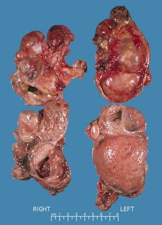 <span class="mw-page-title-main">Multiple endocrine neoplasia type 2</span> Medical condition