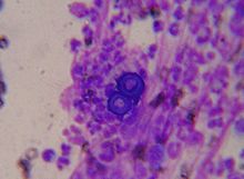 Blastomyces dermatitidis Blastomycosis cropped.JPG