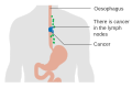 Esophageal cancer with spread to lymph nodes