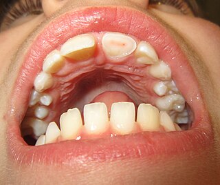 <span class="mw-page-title-main">Dental trauma</span> Medical condition