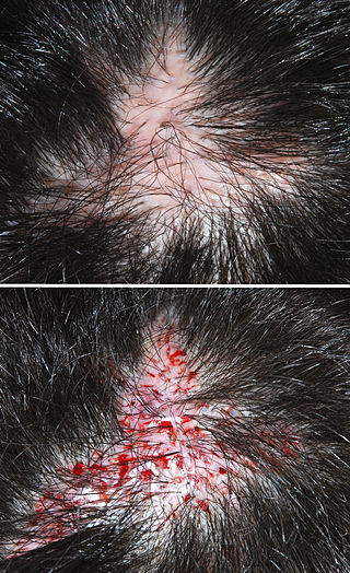 <span class="mw-page-title-main">Hair transplantation</span> Surgical operation to relocate hair follicles