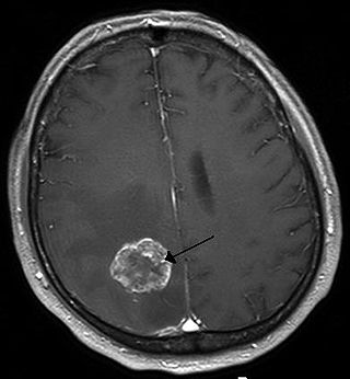 <span class="mw-page-title-main">Brain tumor</span> Neoplasm in the brain