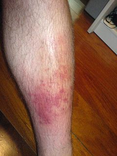 Cellulitis Bacterial infection of the skin