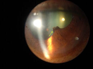 <span class="mw-page-title-main">Synechia (eye)</span> Condition in which the iris adheres to the cornea or lens