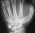 Rolando fracture.jpg