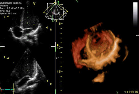 صورة ثُلاثيَّة الأبعاد لِتخطيط صدى القلب تُظهر تحرُّكات الصمام التاجي على جهاز الموجات فوق الصوتية