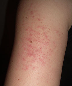 Keratosis pilaris arm.jpg