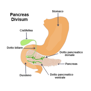 <span class="mw-page-title-main">Pancreas divisum</span> Congenital disorder of digestive system