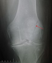 A vertical patella fracture with the fracture line marked by a black arrow Patella fracture.JPG