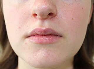 <span class="mw-page-title-main">Perioral dermatitis</span> Medical condition