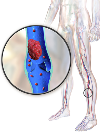 <span class="mw-page-title-main">Hughes–Stovin syndrome</span> Autoimmune disorder