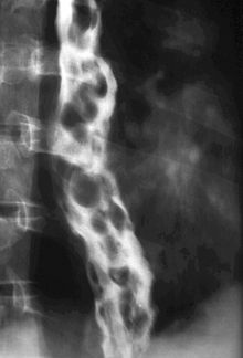 X-ray of a person with dilated, snake-like varicose veins in their esophagus secondary to pulmonary hypertension Radiology 0045 Nevit.jpg