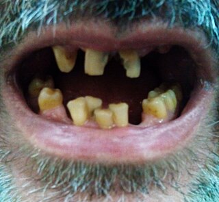 <span class="mw-page-title-main">Tooth discoloration</span> Medical condition