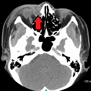 <span class="mw-page-title-main">Dacryocystitis</span> Medical condition