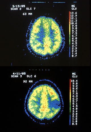 <span class="mw-page-title-main">Astrocytoma</span> Medical condition